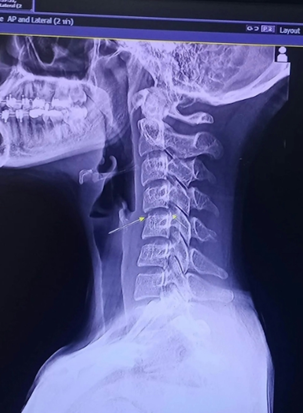 就醫時才發現原來頸椎早已受傷，在接受按摩後更導致神經受損