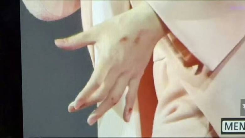 阿信右手上有5個擦傷的血痕