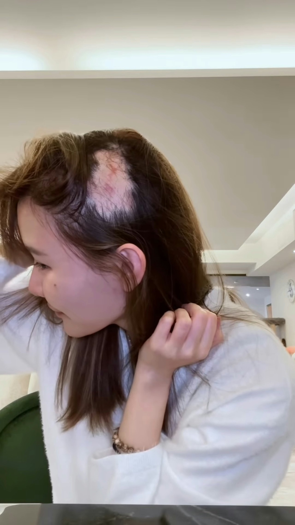 至於頭部左面就發現脫髮面積非常廣，而且光禿禿的頭皮見到有一、兩撻紅印，予人感覺是寸草不生。