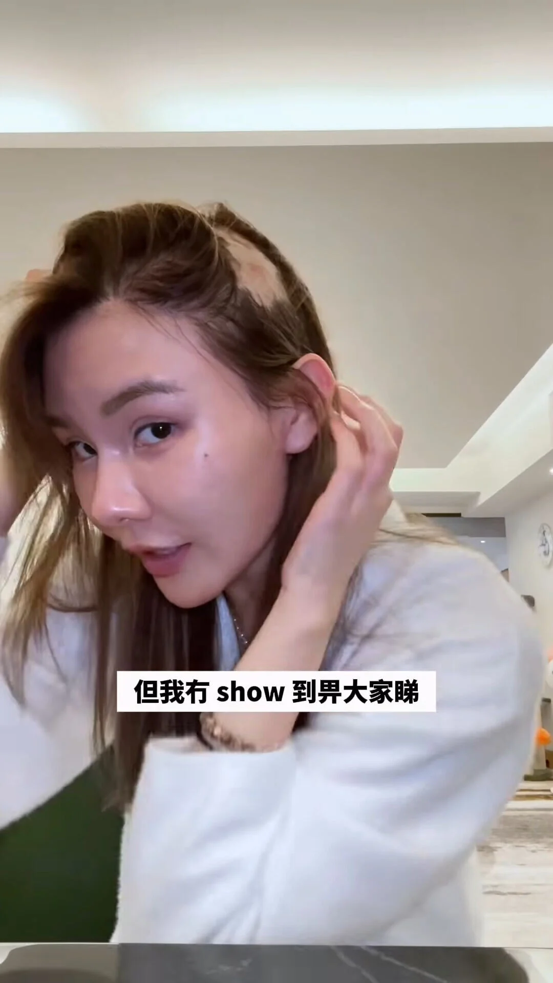 片中見她拿起左右兩側稀薄的頭髮，右面靠額頭的位置見到出現光禿禿的頭皮，面積跟她的頭頂相若。