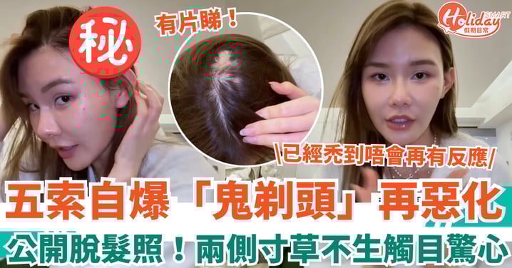 五索自爆「鬼剃頭」再惡化 公開脫髮照兩側寸草不生：已經禿到唔會再有反應！