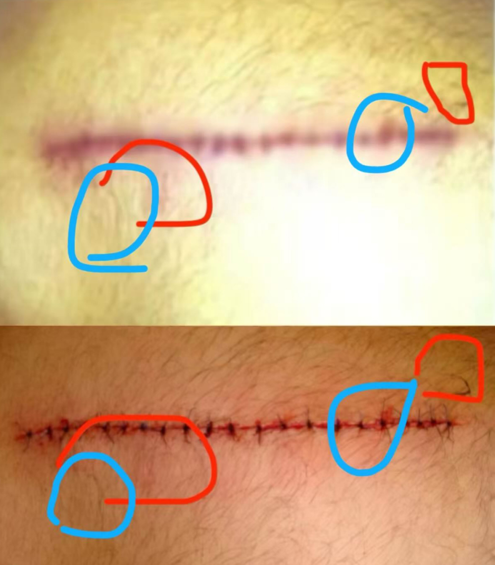 橫豎研究所透露爆料者在美國遇襲，然而卻被發現傷口照出自網路