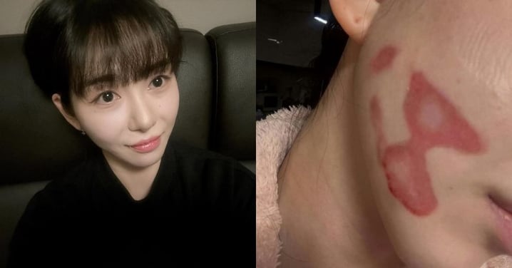前AOA成員權珉娥「毀容」了！臉部因醫美二度灼傷「猙獰紅疤曝」